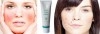 produit de peau pou f/h